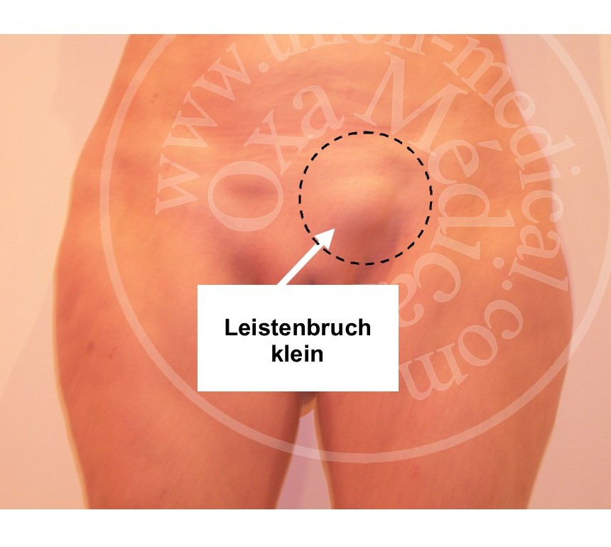 Foto eines kleinen Leistenbruchs
